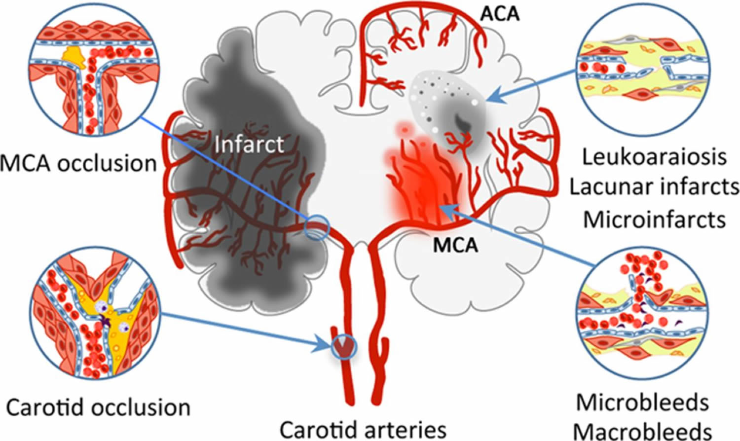 Is Vascular Dementia A Mental Illness