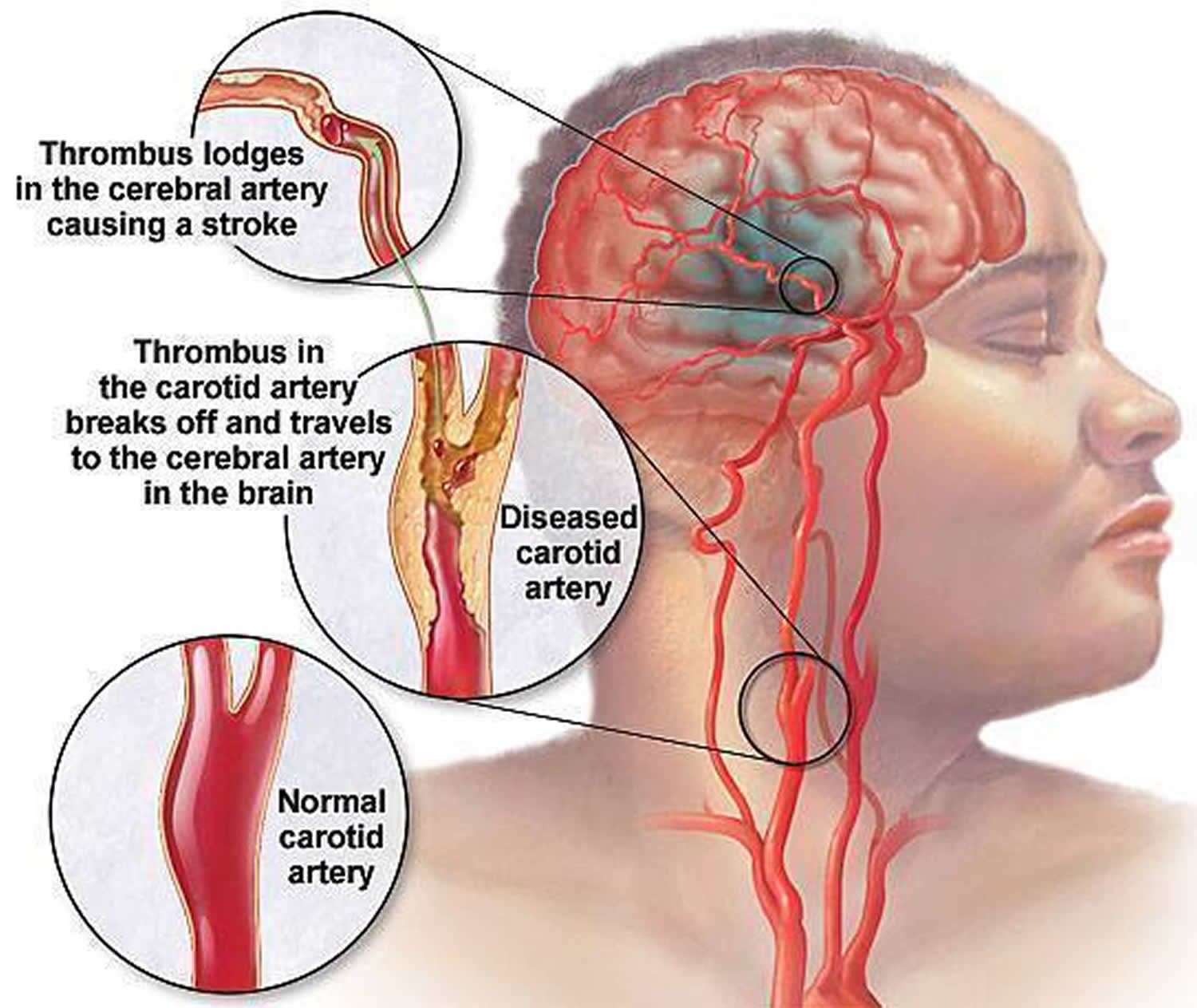 coronary-artery-calcification-causes-symptoms-treatment-2023