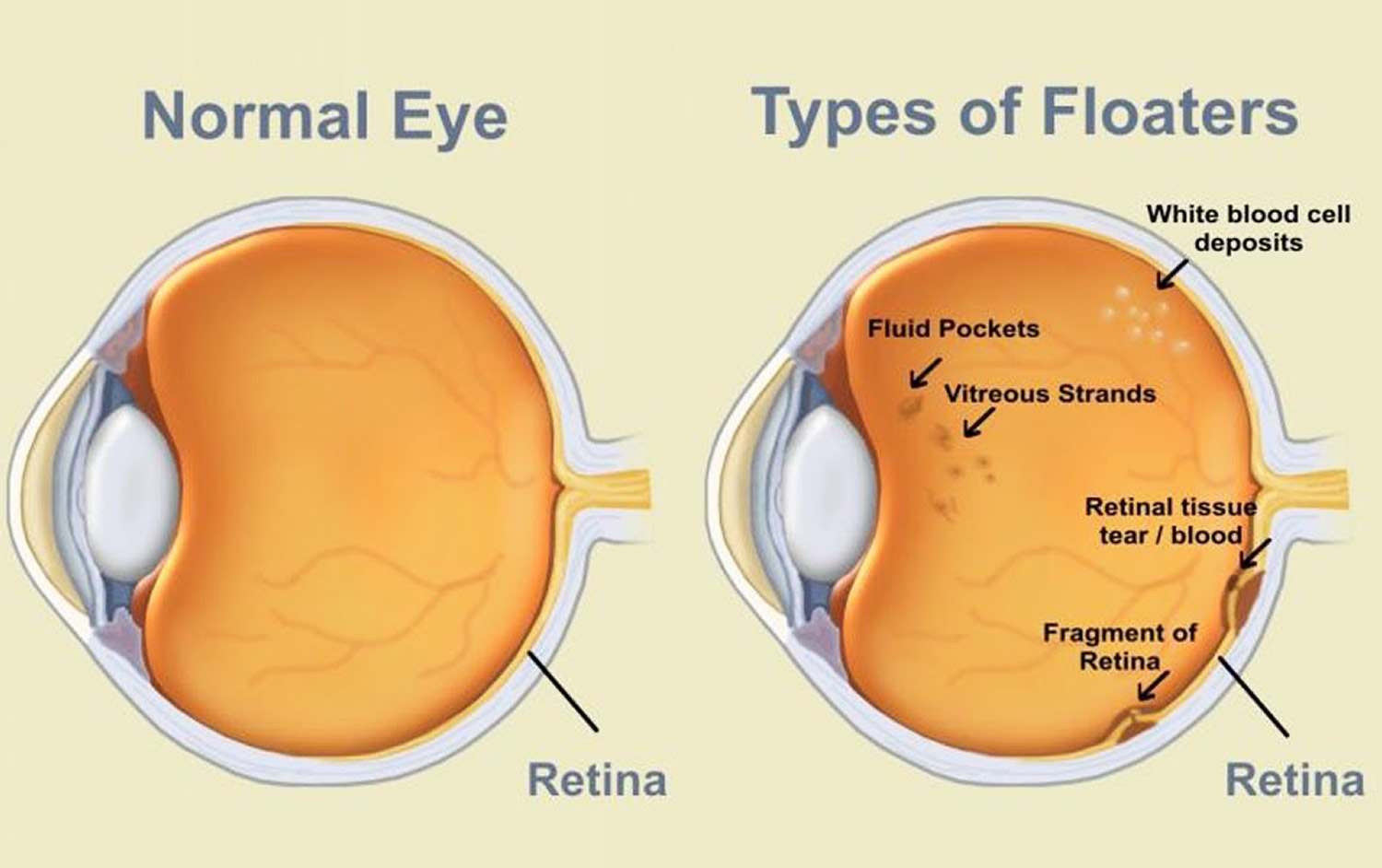 Eye Floaters, Black Eye Floaters and Eye Flashes Causes and Treatment