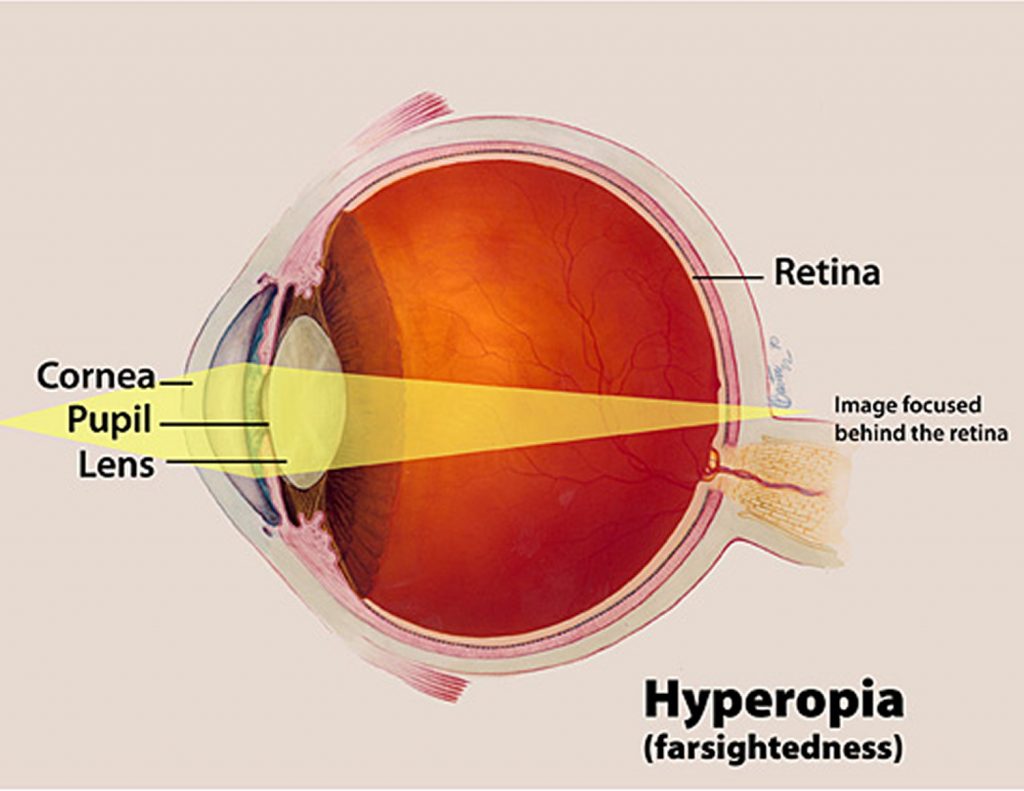 What is Astigmatism Causes, Symptoms,Treatment