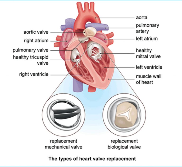 heart-surgery-types-open-bypass-ablation-heart-valve-surgery