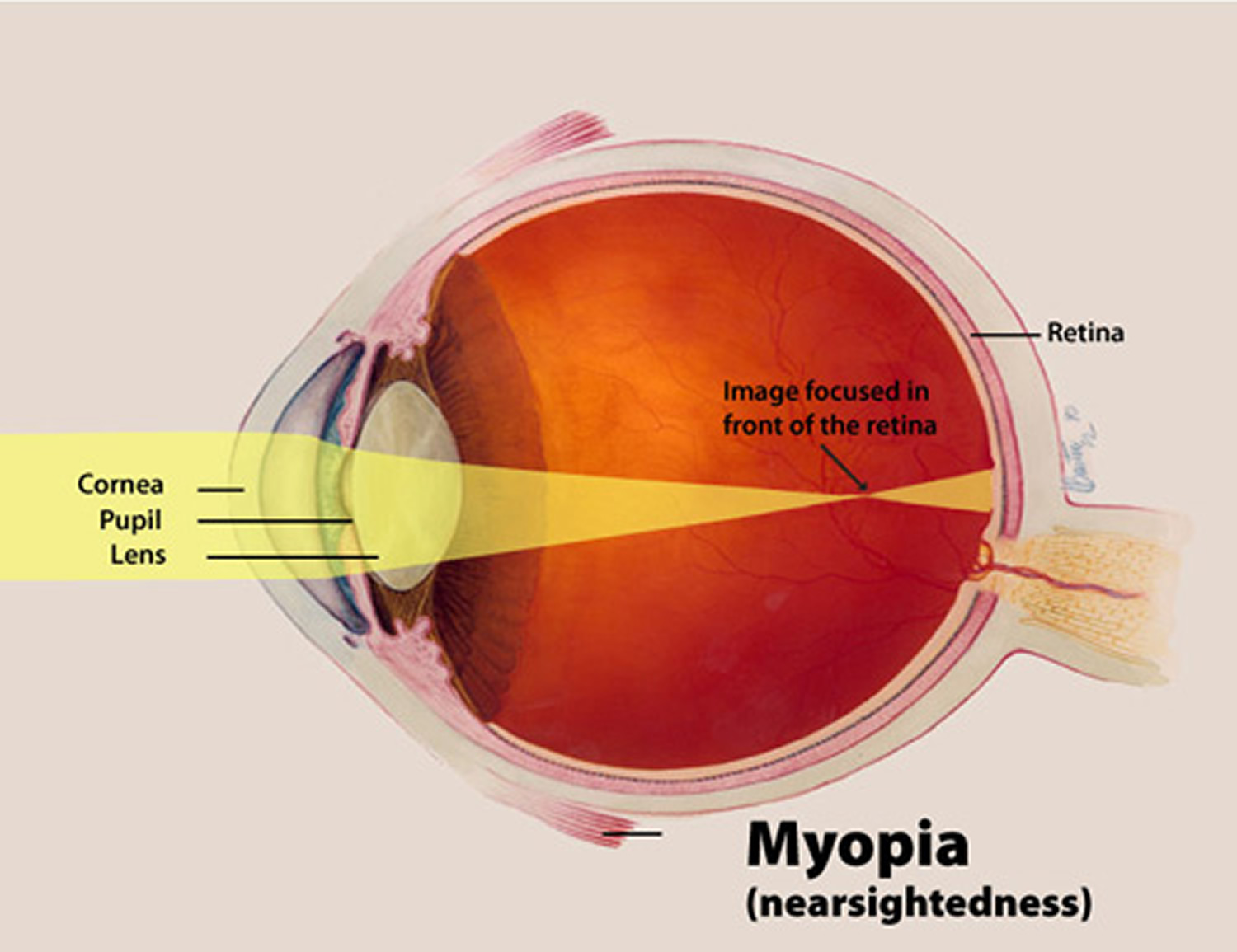 What Is Astigmatism - Causes, Symptoms,Treatment