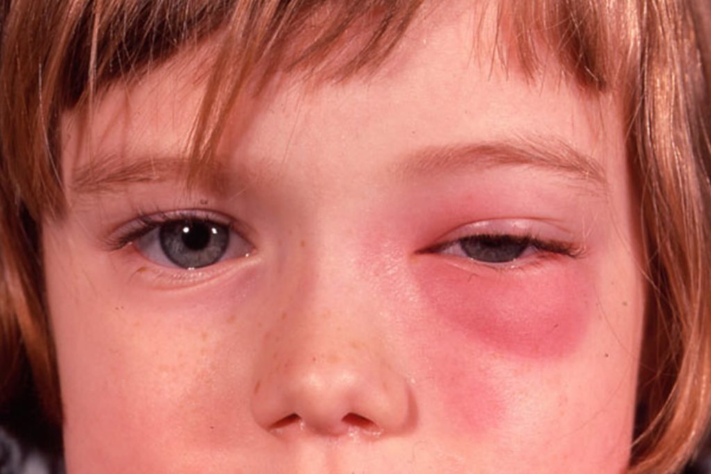 Eye Infections In Baby, Children & Adults - Causes, Diagnosis & Treatment