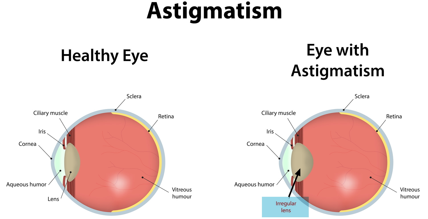 hyperopia-farsighted-vision-causes-symptoms-diagnosis-treatment