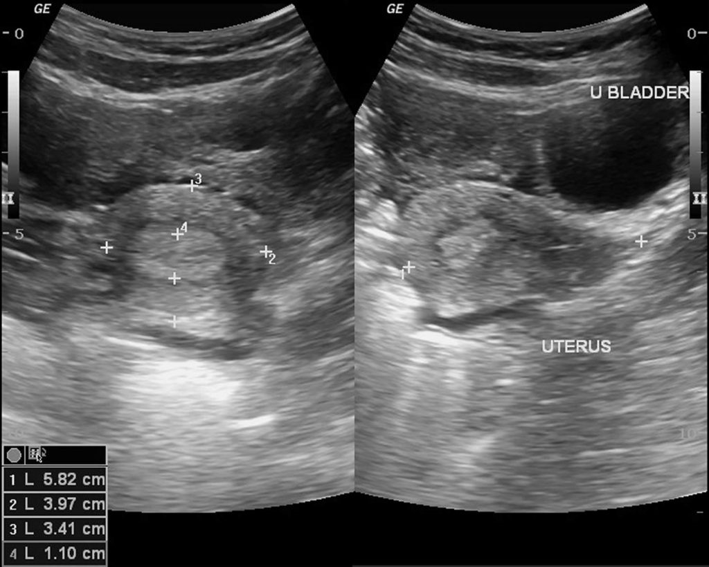 Ovarian Cyst Types Symptoms Pain Diagnosis And Treatment