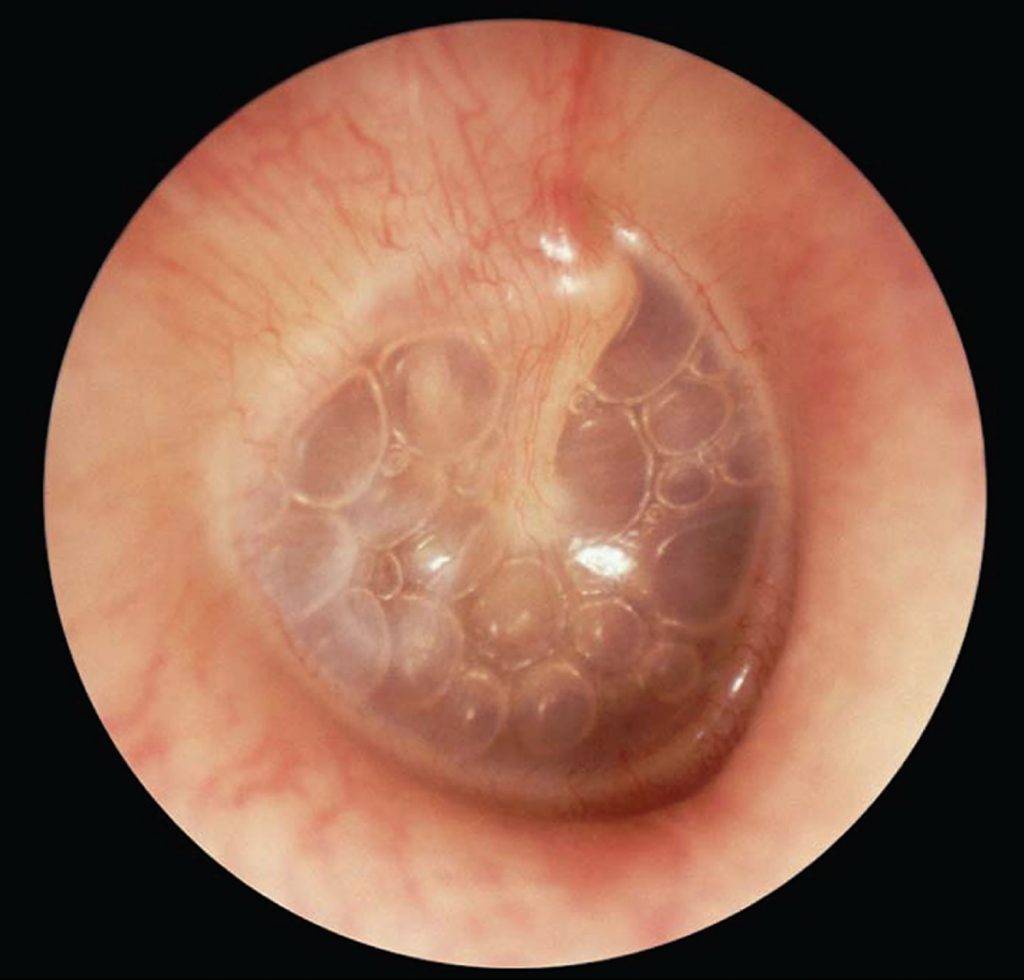 Middle Ear Infection & Middle Ear Effusion - Causes & Treatment