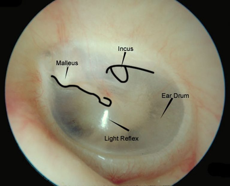Ear Drum Anatomy, Causes, Diagnosis & Treatment for Busted Ear Drum