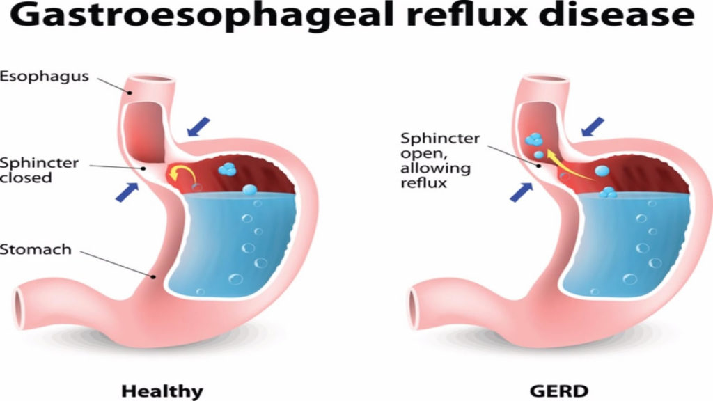 Fundoplication Surgery - GERD Surgery, Nissen Fundoplication