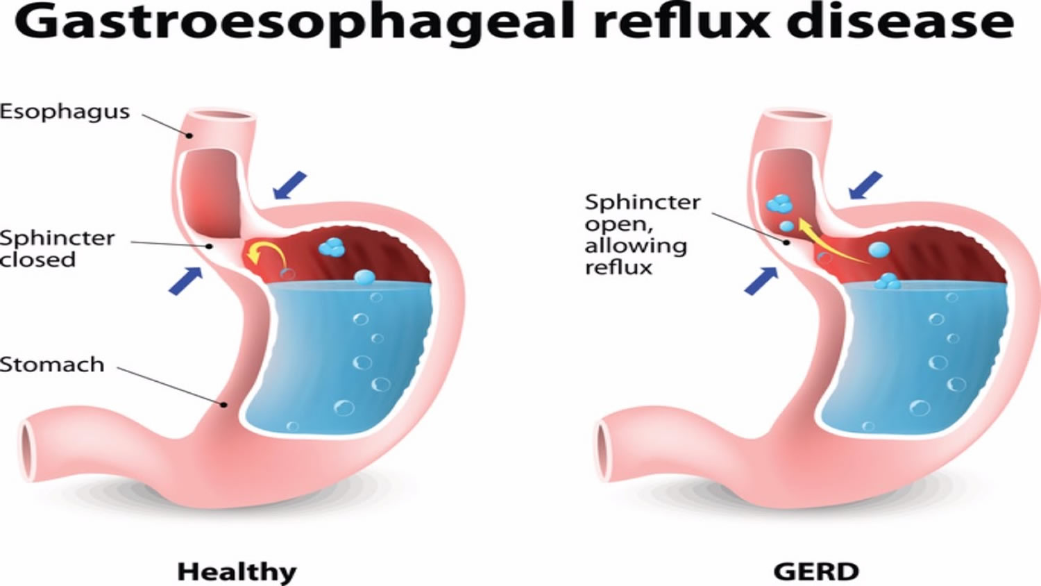 Esophagitis Causes Treatment For Eosinophilic Reflux Erosive