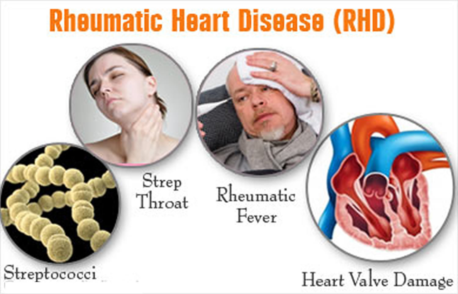 Rheumatic Heart Disease Signs And Symptoms