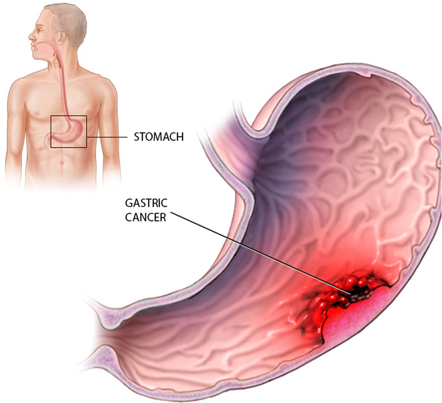 what-is-abdominal-cancer-with-pictures