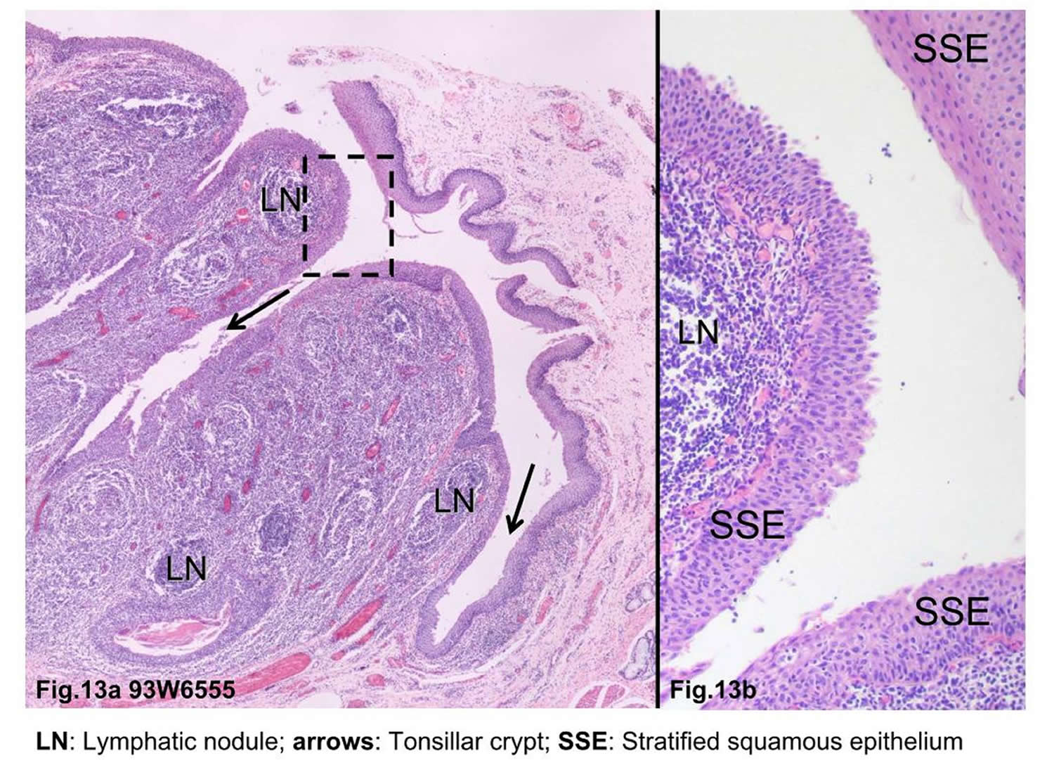 Tonsil stones causes, symptoms, diagnosis and tonsil stones treatment