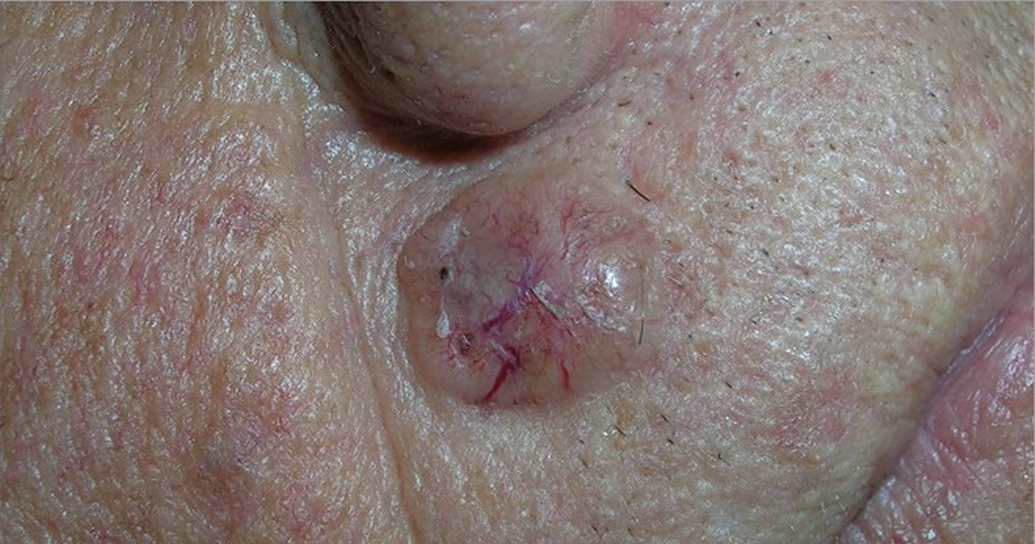 Basal Cell Skin Cancer Moles