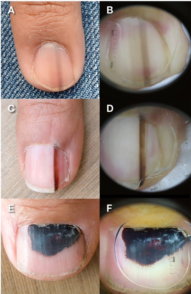 Fingernails - Ingrown fingernails - Dark Line - Fingernail Pain