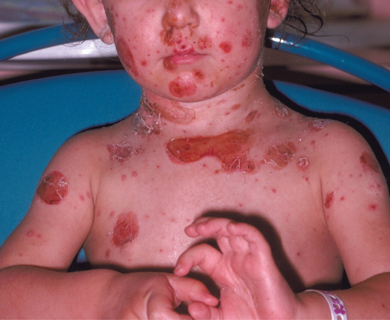 Impetigo - Causes, Symptoms, Treatment, Prevention & Home Treatment