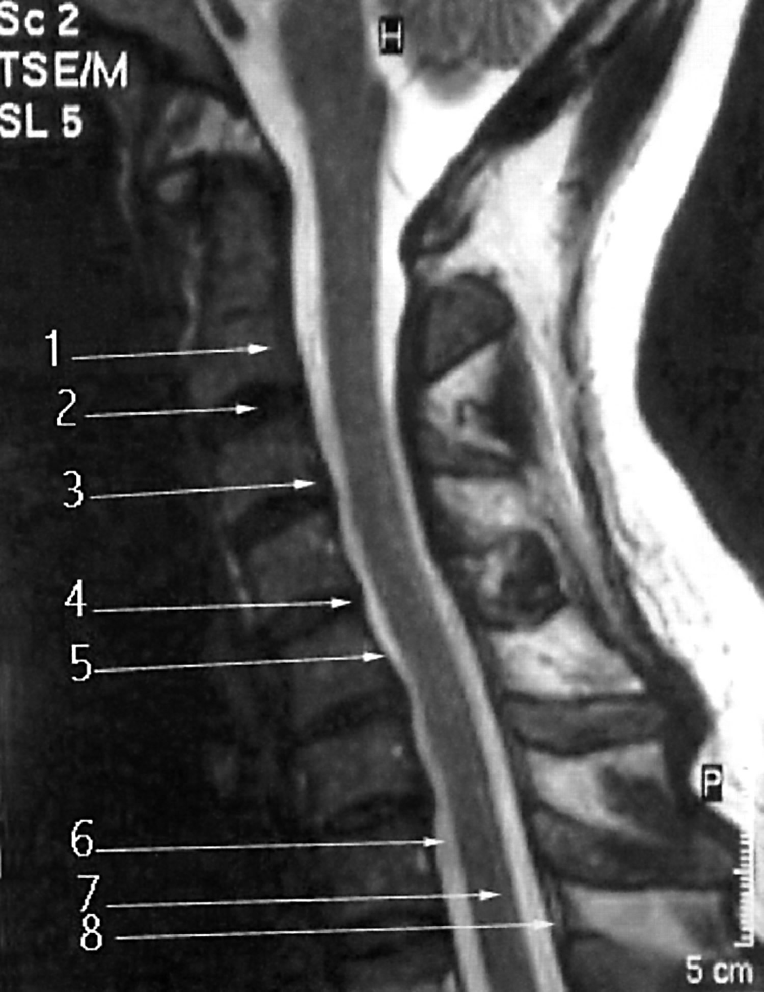 Spinal Cord Compression Causes Symptoms Diagnosis And Treatment 9520