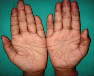 Chilblains Pernio & Chilblain Lupus Erythematosus - Causes & Treatment