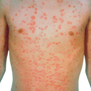 Guttate Psoriasis - Causes, Symptoms, Treatment, Diet & Home Remedy