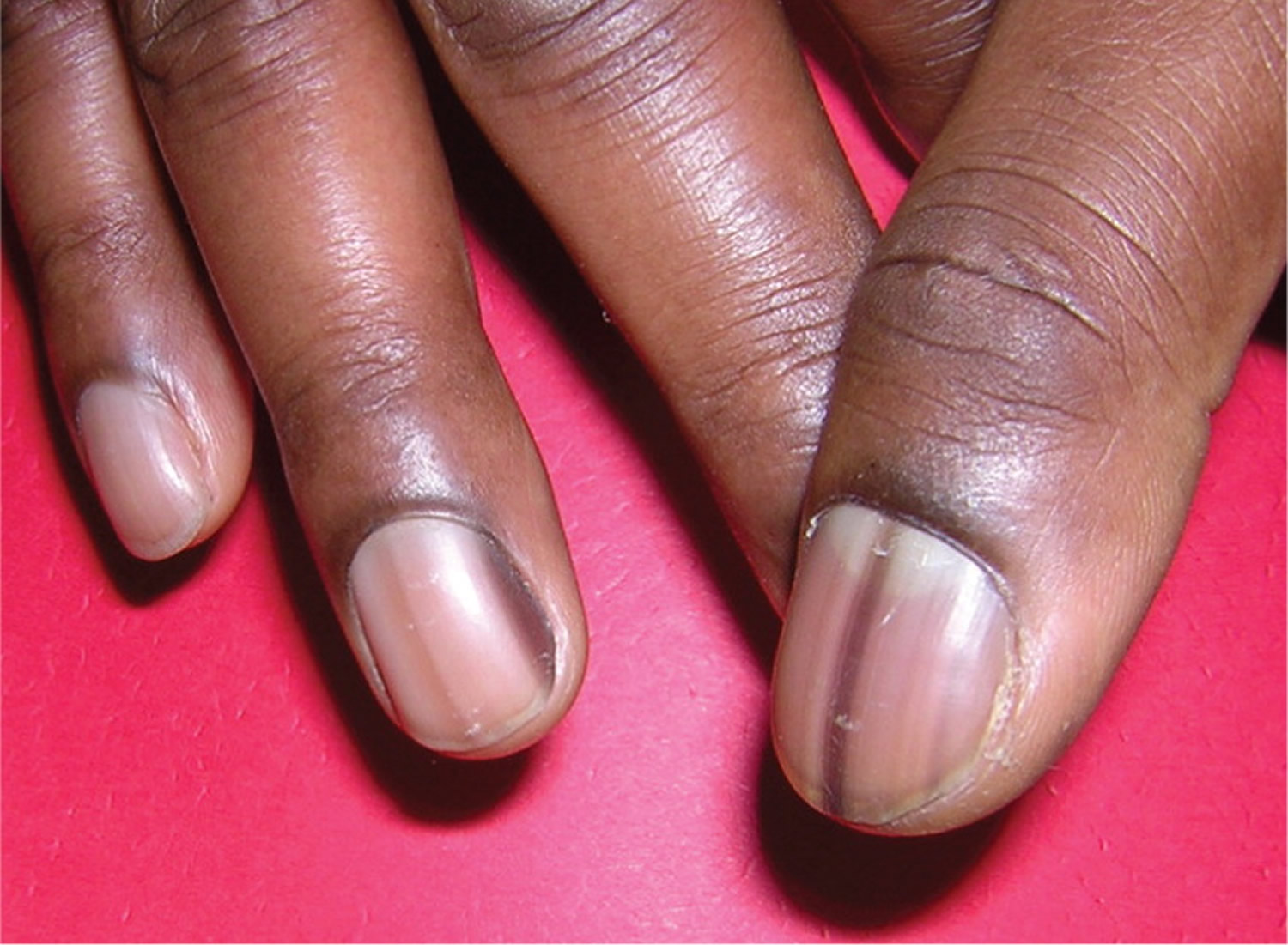 Dark Discoloration On Fingernail