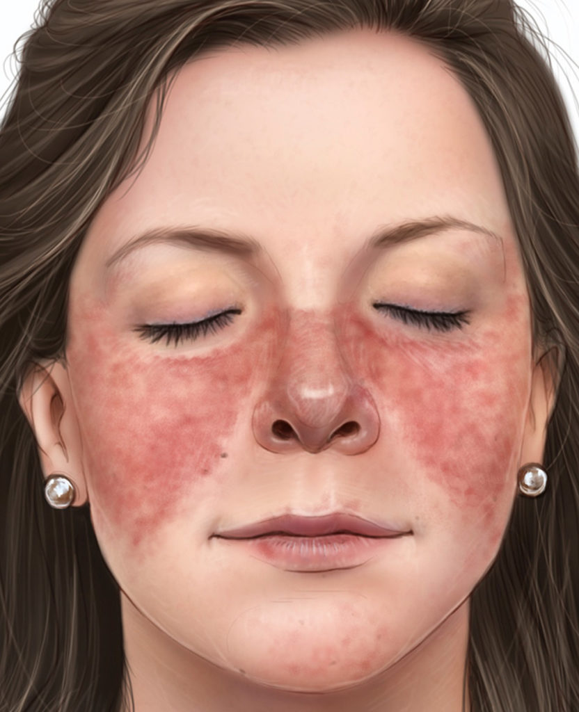 Chilblains Pernio And Chilblain Lupus Erythematosus Causes And Treatment