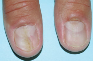 Fingernails - Ingrown fingernails - Dark Line - Fingernail Pain