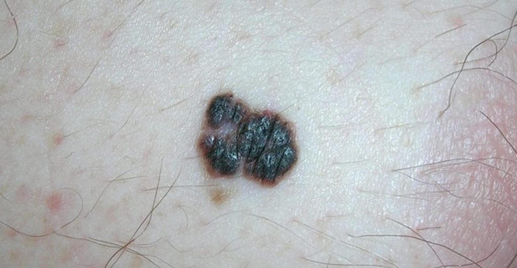 Skin Cancer - Types, Symptoms - Melanoma & Treatment