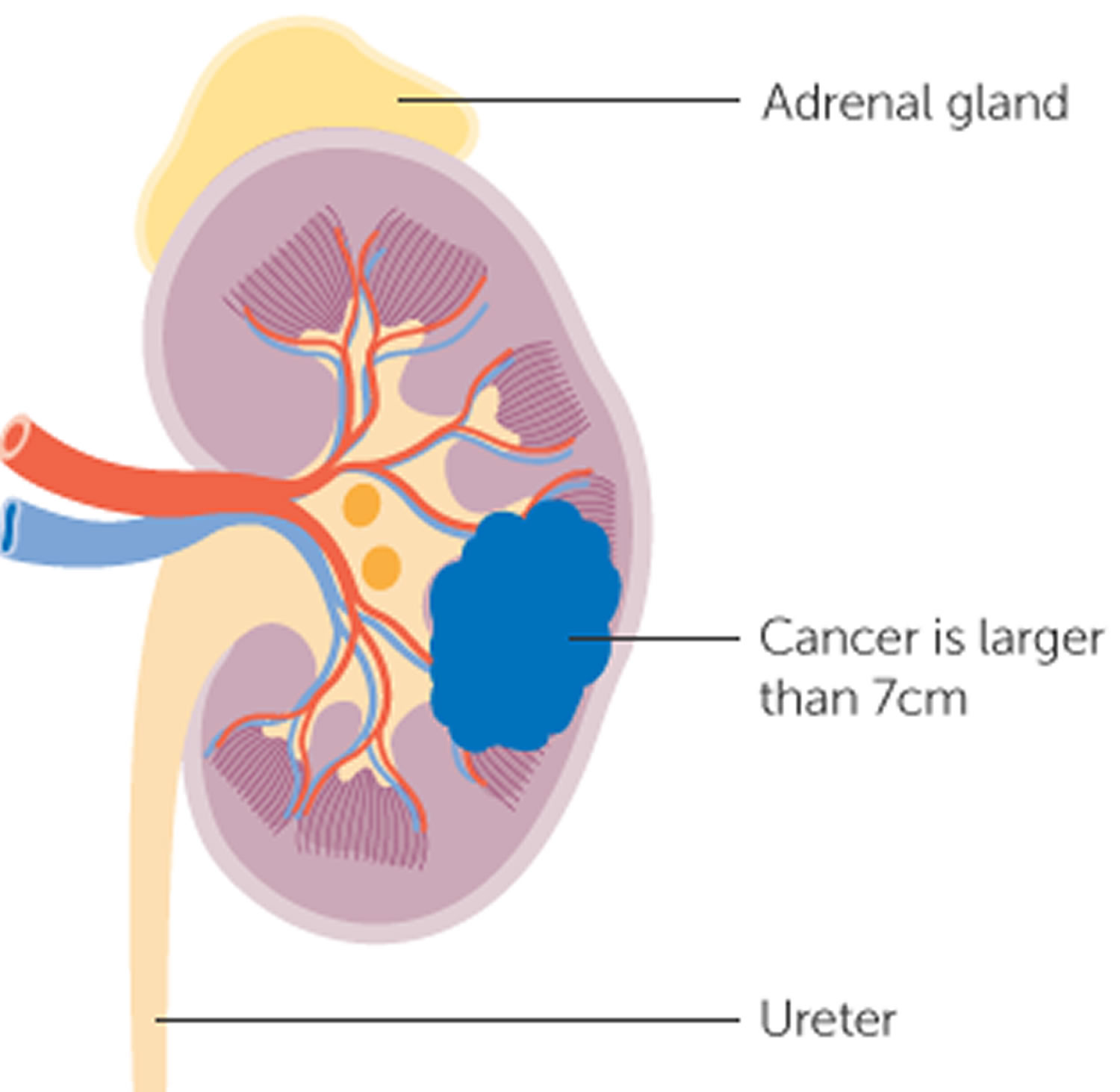 Stage 2 kidney cancer