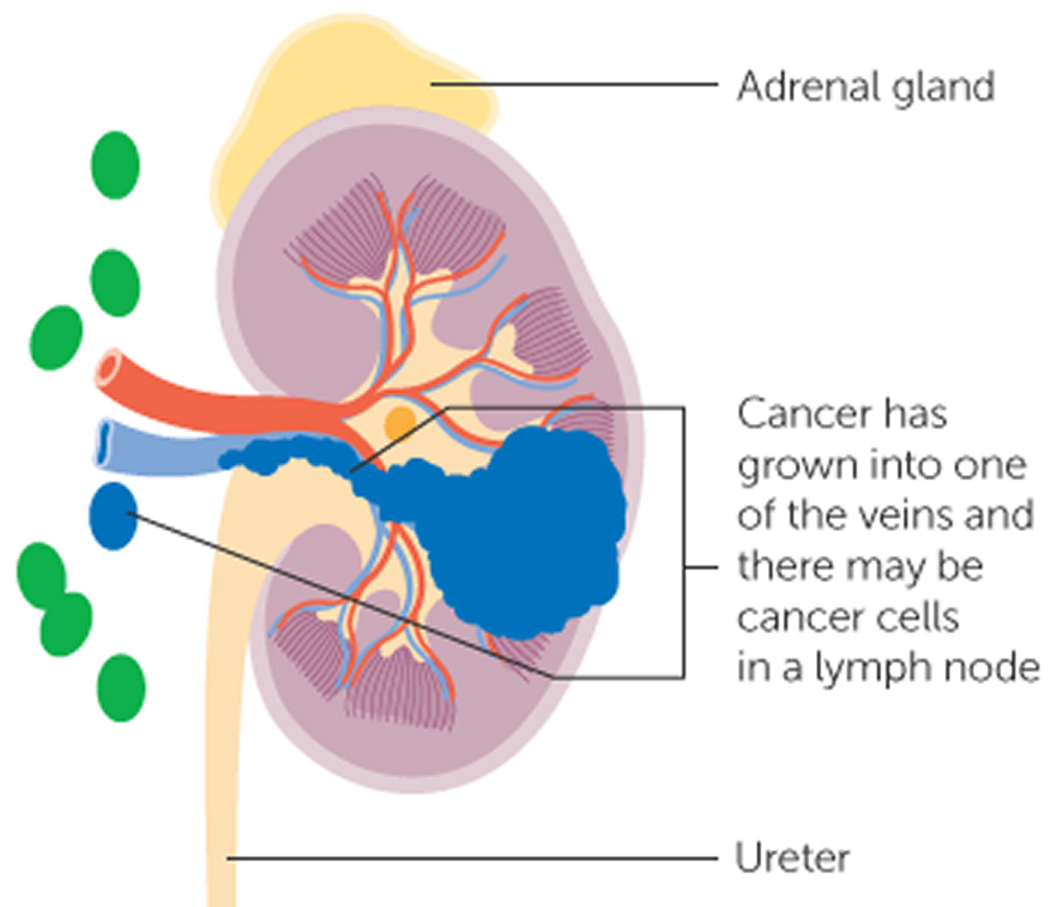 Stage 3 kidney cancer