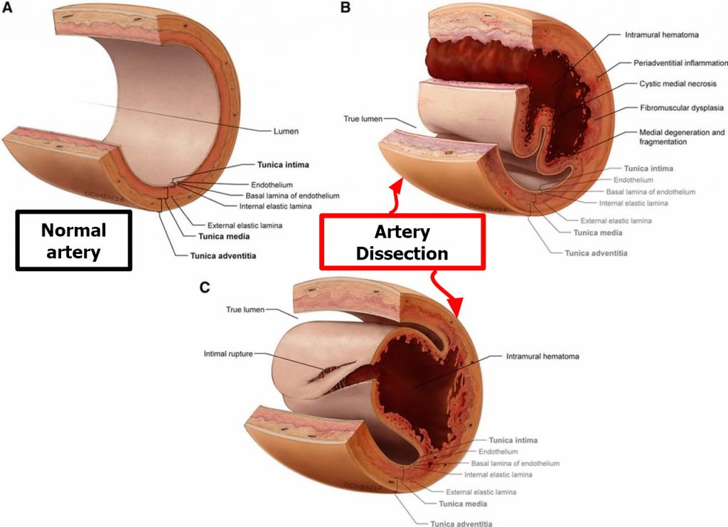 Vertebral Artery Segments Stenosis And Artery Dissection Symptoms 1222