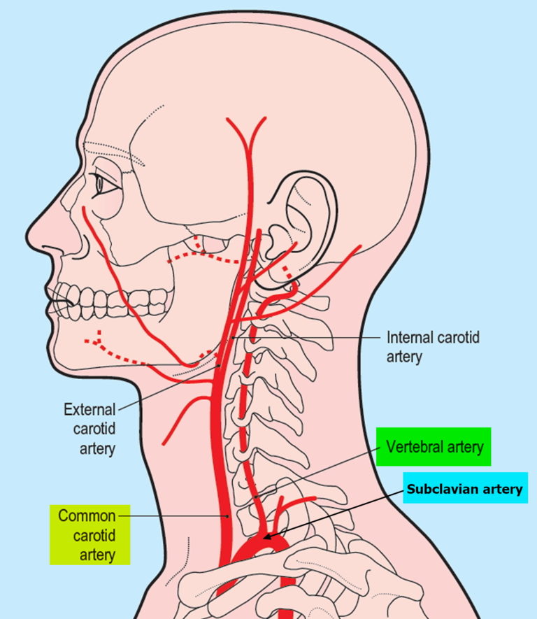 Vertebral Artery Segments Stenosis And Artery Dissection Symptoms