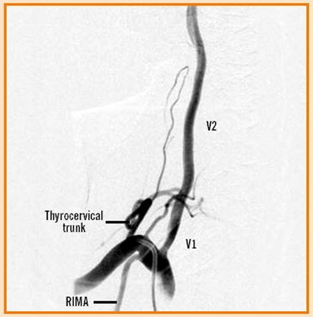 Vertebral Artery Segments Stenosis And Artery Dissection Symptoms 9728