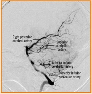 Vertebral Artery Segments, Stenosis and Artery Dissection Symptoms