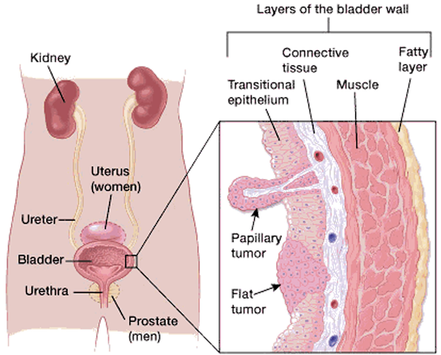 What Are The Signs Of Bladder Cancer In Males / Bladder Cancer In Men | Cxbladder - Even so, the reappearance of hematuria—even weeks or months later—should be a red flag that bladder cancer may be involved.