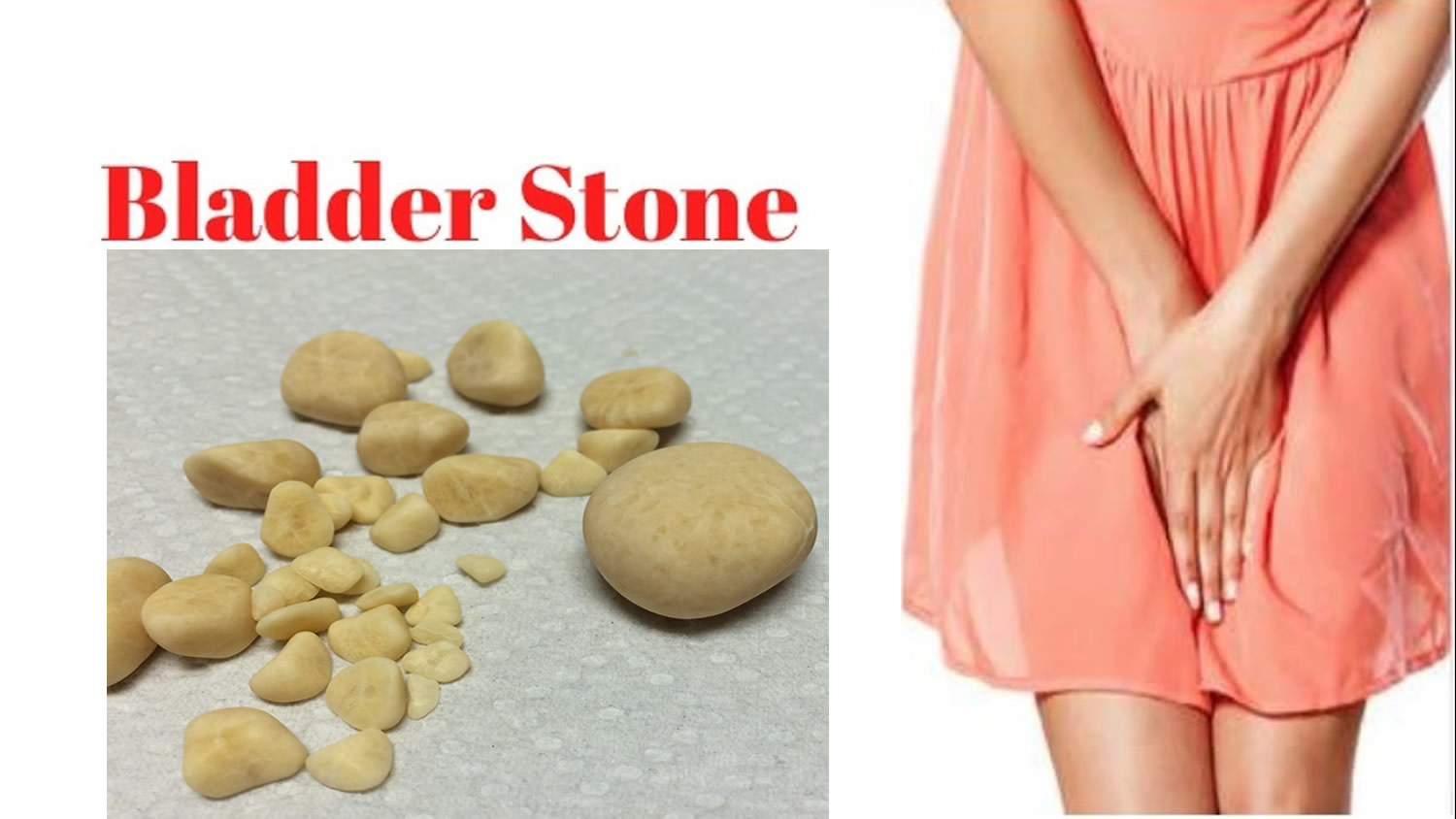 Bladder Stones - Causes, Diagnosis, Symptoms, Removal & Treatment