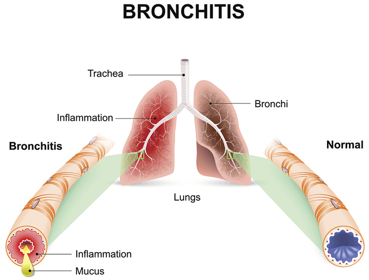 How Long Does Bronchitis Last In Toddlers