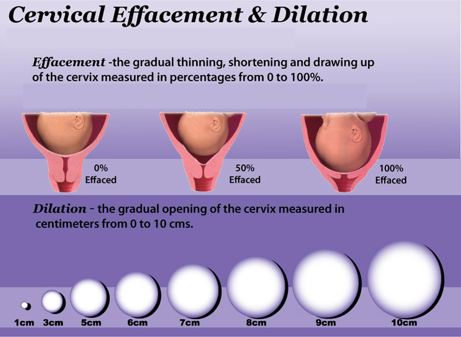 Cervix Effaced, Short, Soft, and Low cervix