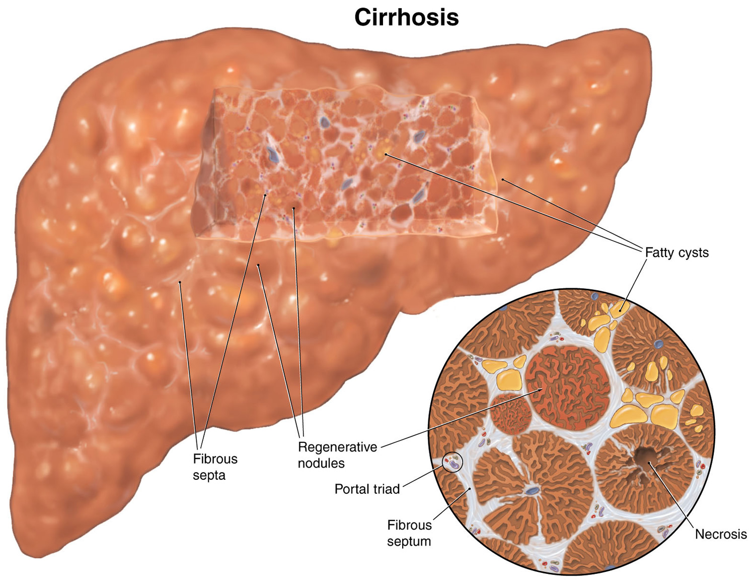 Cirrhosis Of The Liver Symptoms Diagnosis Survival Rate And Treatment 6581