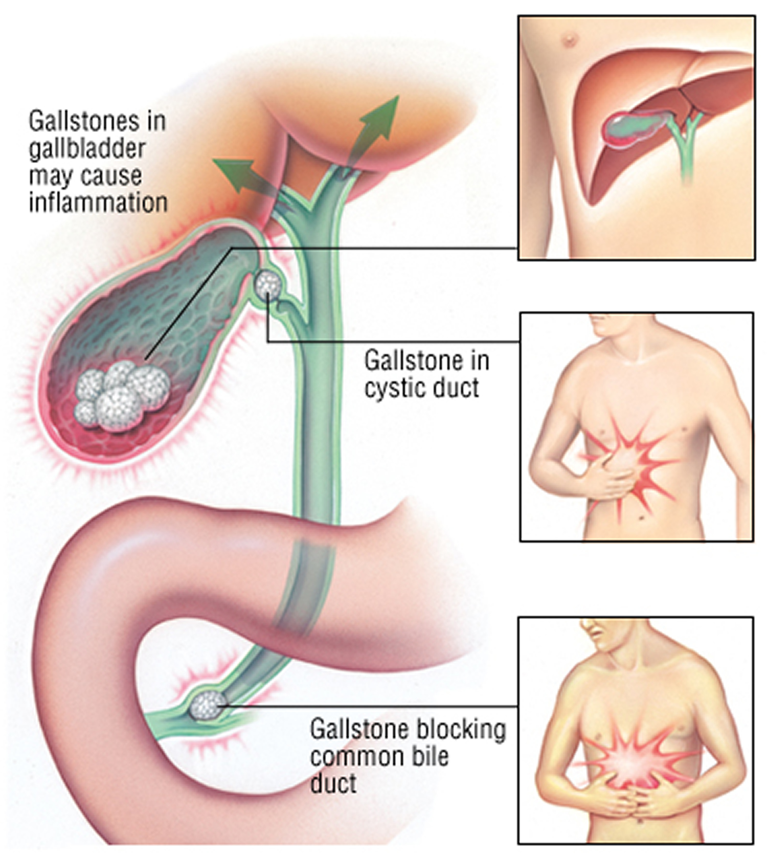 gallbladder-pain-problems-causes-symptoms-diganosis-treatment