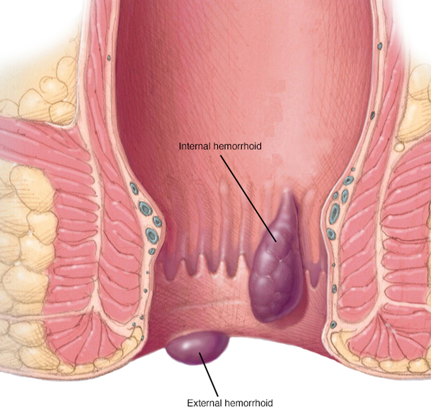 Anal fissure, causes, signs, symptoms, diagnosis & treatment