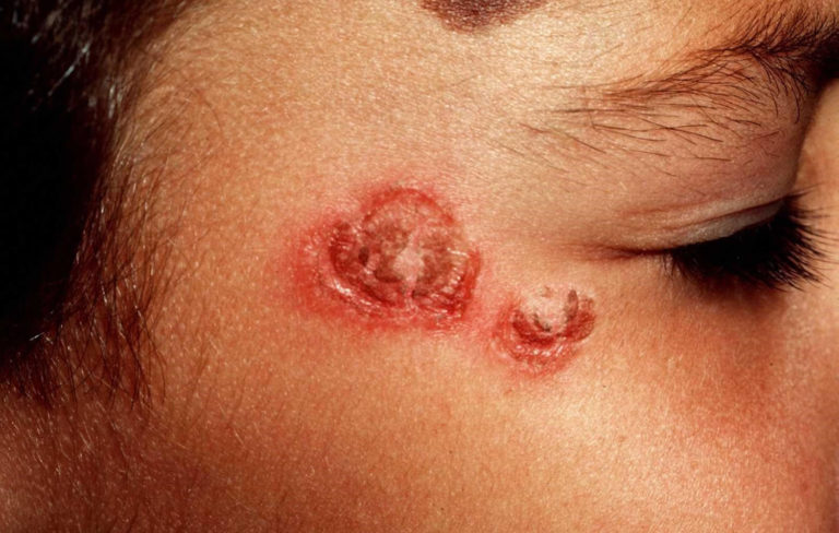 Impetigo - Causes, Symptoms, Treatment, Prevention & Home Treatment