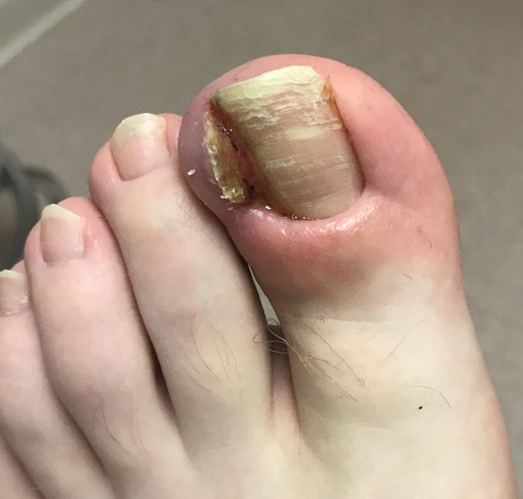 Ingrown Toenail - Causes & How To Treat and Fix Infected Ingrown Toenail