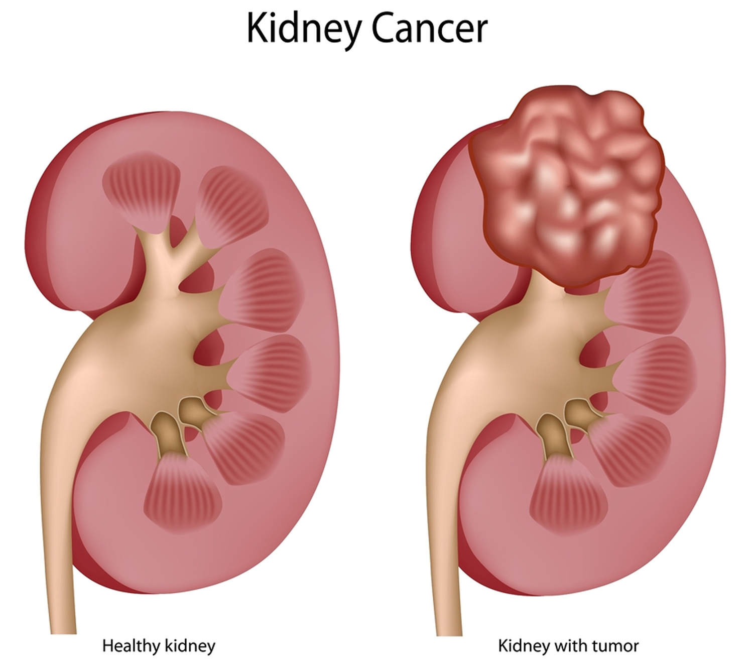 How Does Kidney Cancer Affect The Body