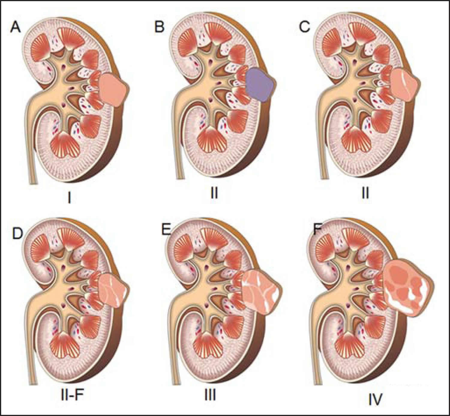 bosniak cyst        
        <figure class=