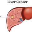liver cancer