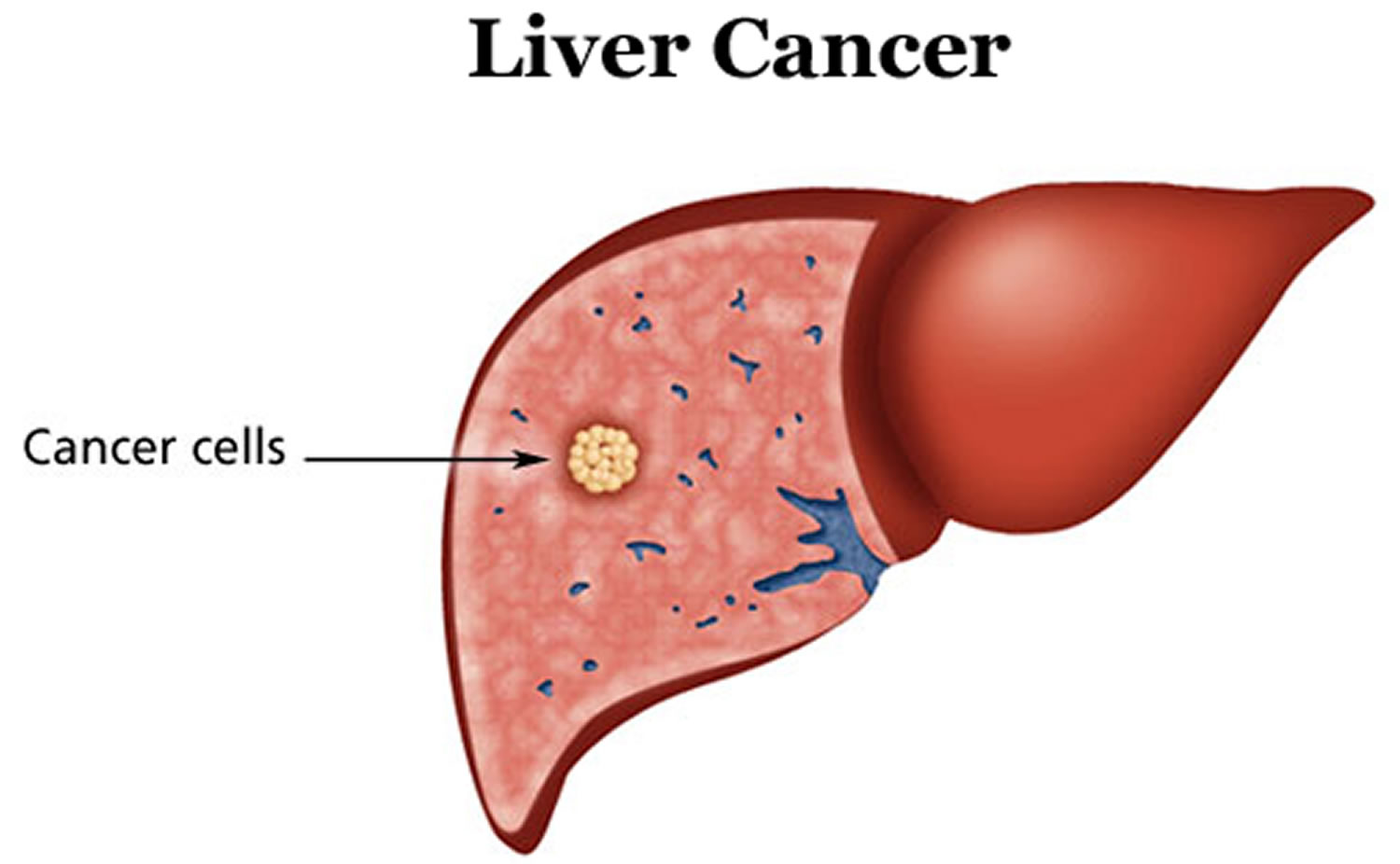 Liver Cancer Causes Symptoms Diagnosis Prognosis And Treatment