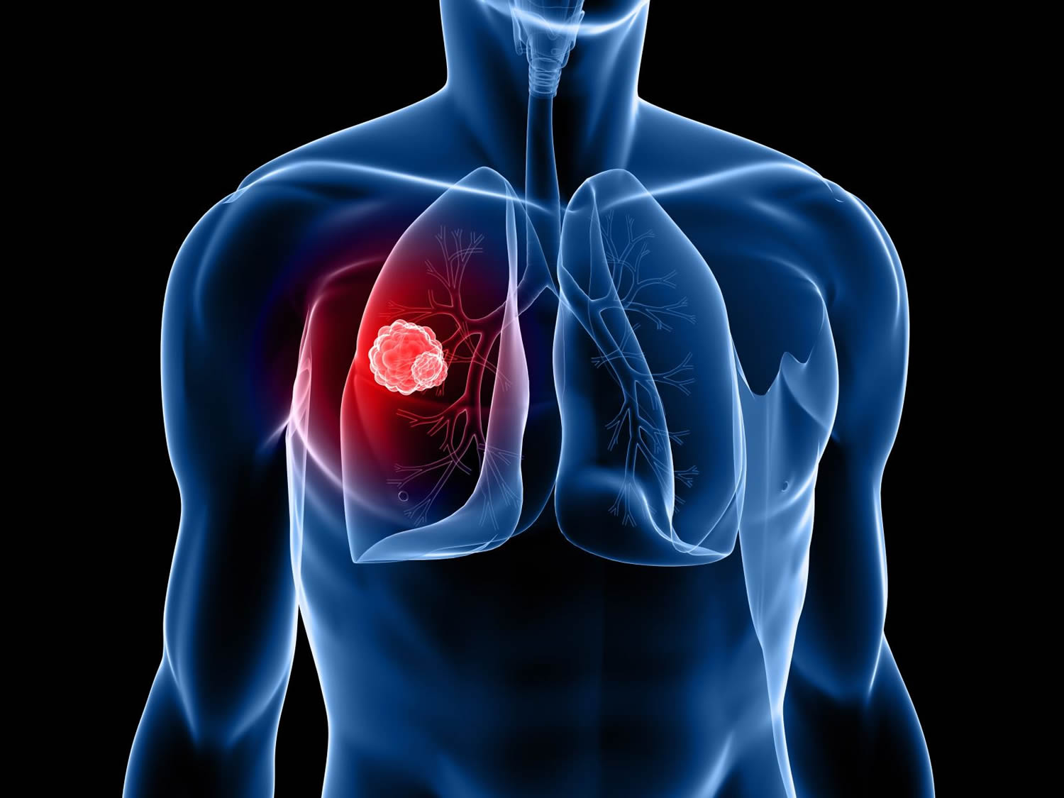 Lung Cancer Causes Diagnosis Symptoms Treatment