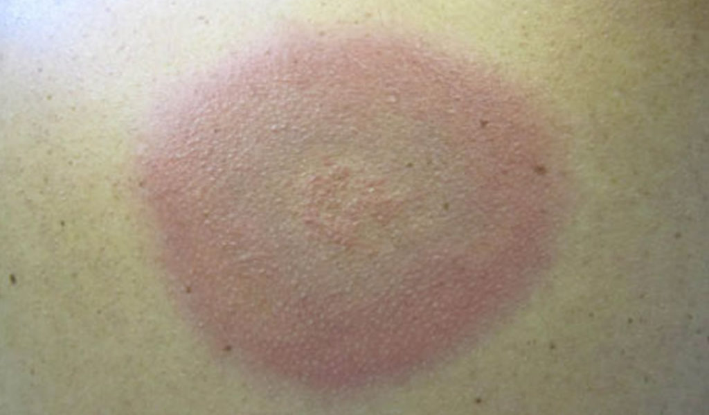Lyme Disease Rash, Causes, Symptoms, Diagnosis and Treatment