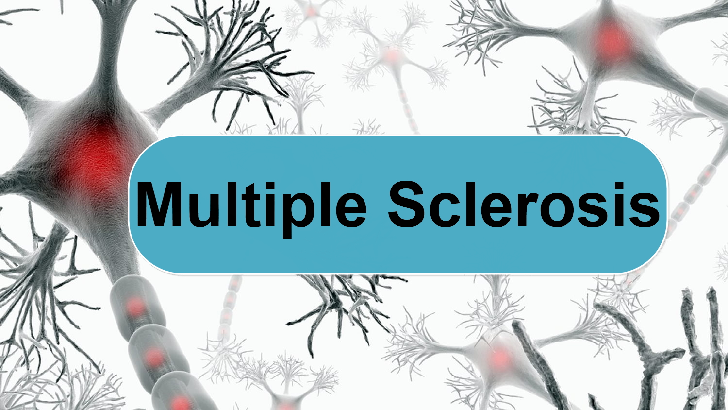 Multiple Sclerosis - Causes, Symptoms, Signs, Diagnosis and Treatment