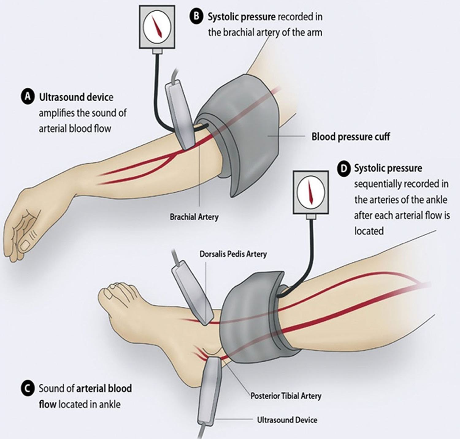 Peripheral Artery Disease Causes Symptoms Treatment