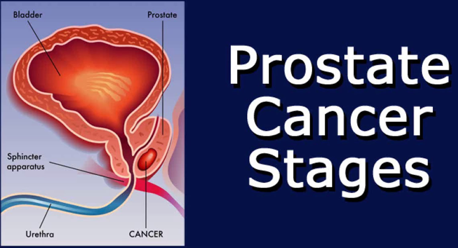 How Fast Does Aggressive Prostate Cancer Spread To The Bones